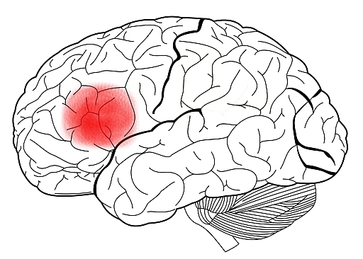 An illustration of the human brain with Broca's Area highlighted. An illustration of the human brain with Broca's Area highlighted.
