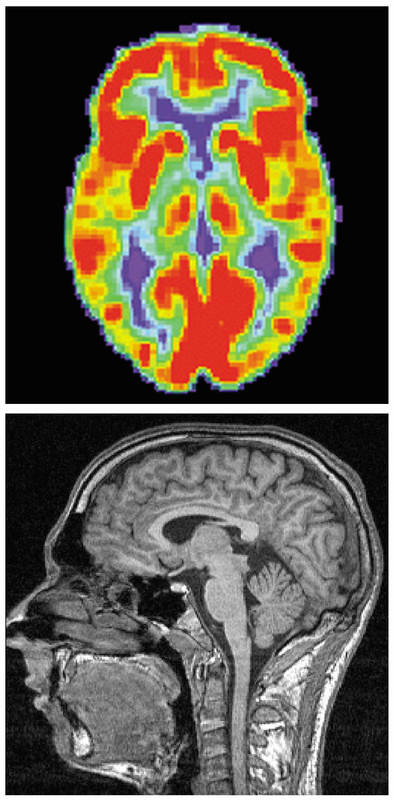 A PET scan of the human brain showing areas of red, green, blue, yellow, and purple: An fMRI of the human brain showing differing shades of gray. A PET scan of the human brain showing areas of red, green, blue, yellow, and purple: An fMRI of the human brain showing differing shades of gray.