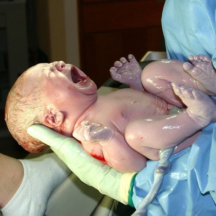 An infant, with umbilical cord still attached, is cradled in a nurse's arms shortly after birth. An infant, with umbilical cord still attached, is cradled in a nurse's arms shortly after birth.
