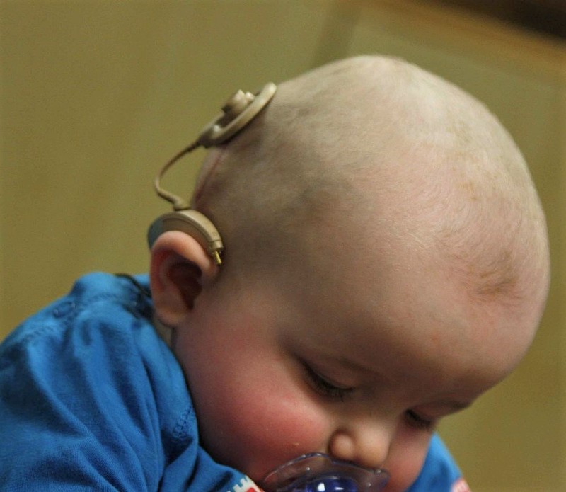 An infant with a cochlear implant. An infant with a cochlear implant.