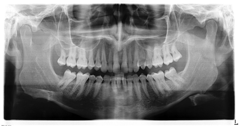 Dental x-rays of an adult. Dental x-rays of an adult.