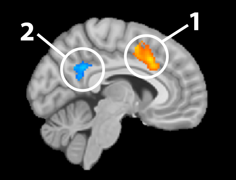 Example of fMRI analyses overlaid on an sMRI image. Example of fMRI analyses overlaid on an sMRI image.