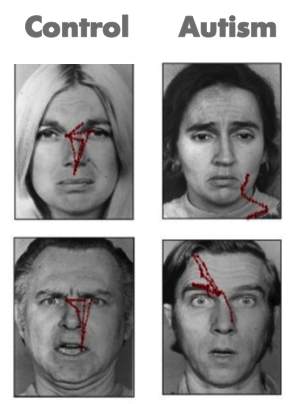 Four faces are displayed each with red lines showing patterns of eye movements. The faces observed by study participants without autism show red lines in a roughly triangular pattern from the eyes to the mouth. The faces shown to participants with autism show lines with no discernible pattern and not focused near the eyes or mouth. Four faces are displayed each with red lines showing patterns of eye movements. The faces observed by study participants without autism show red lines in a roughly triangular pattern from the eyes to the mouth. The faces shown to participants with autism show lines with no discernible pattern and not focused near the eyes or mouth.