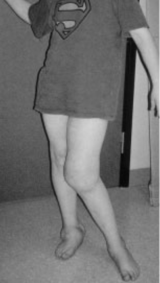 A boy with a swollen and deformed knees and ankle. A boy with a swollen and deformed knees and ankle.
