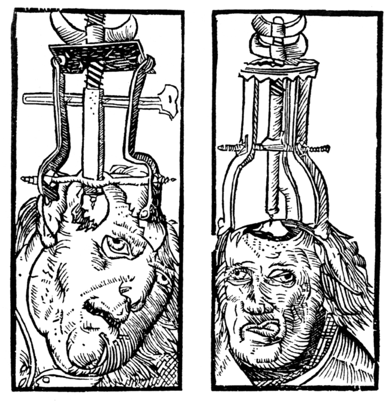 Engraving by Peter Treveris of a trepanation. A type of drill is clamped onto the head and used to bore a hole through the skull and expose the dura matter. Engraving by Peter Treveris of a trepanation. A type of drill is clamped onto the head and used to bore a hole through the skull and expose the dura matter.